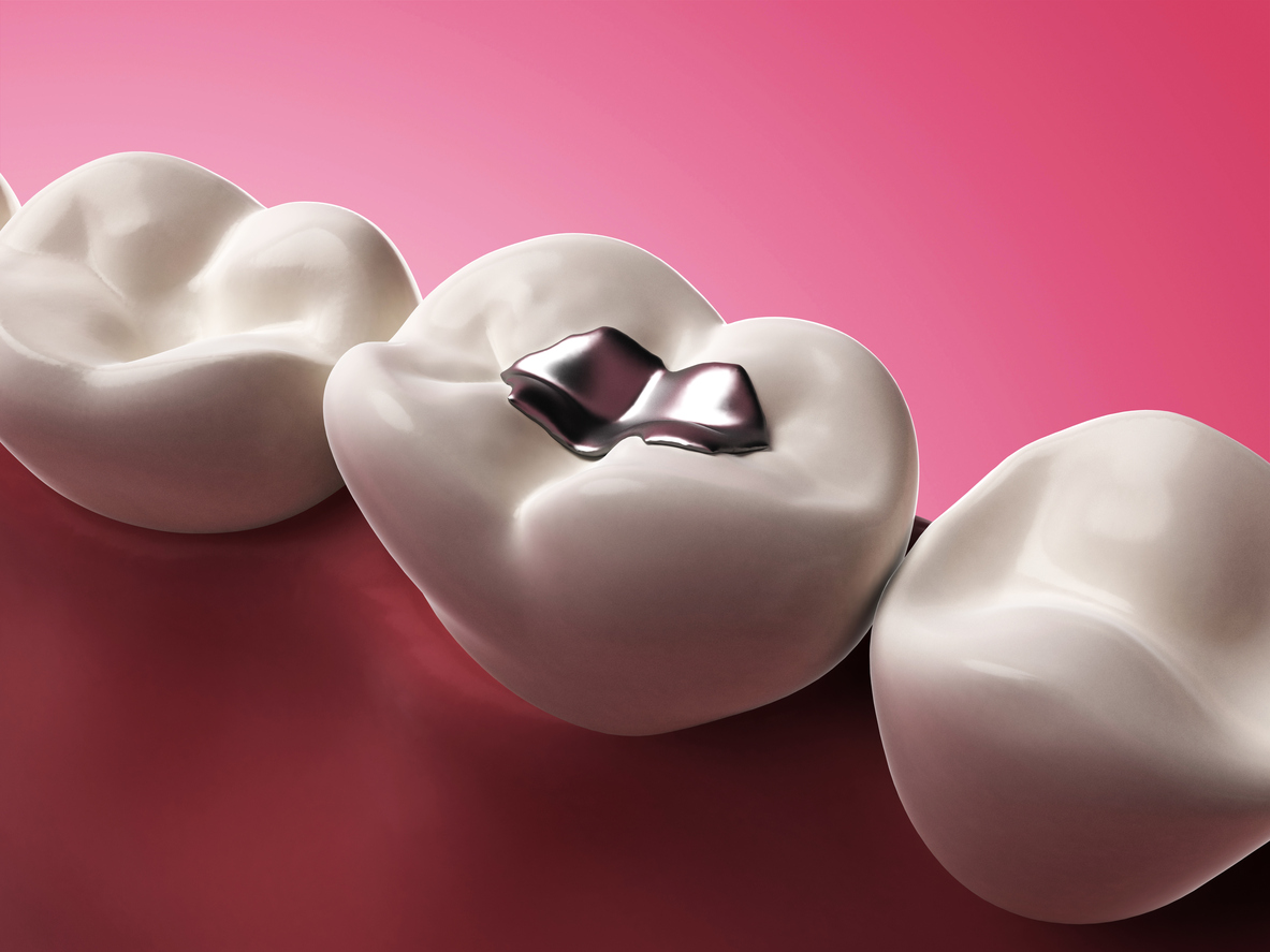 Amalgam vs. Composite Resin Fillings Dental South P.A.